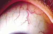 Sclerology - study of the eye's red lines Sclerology Pic